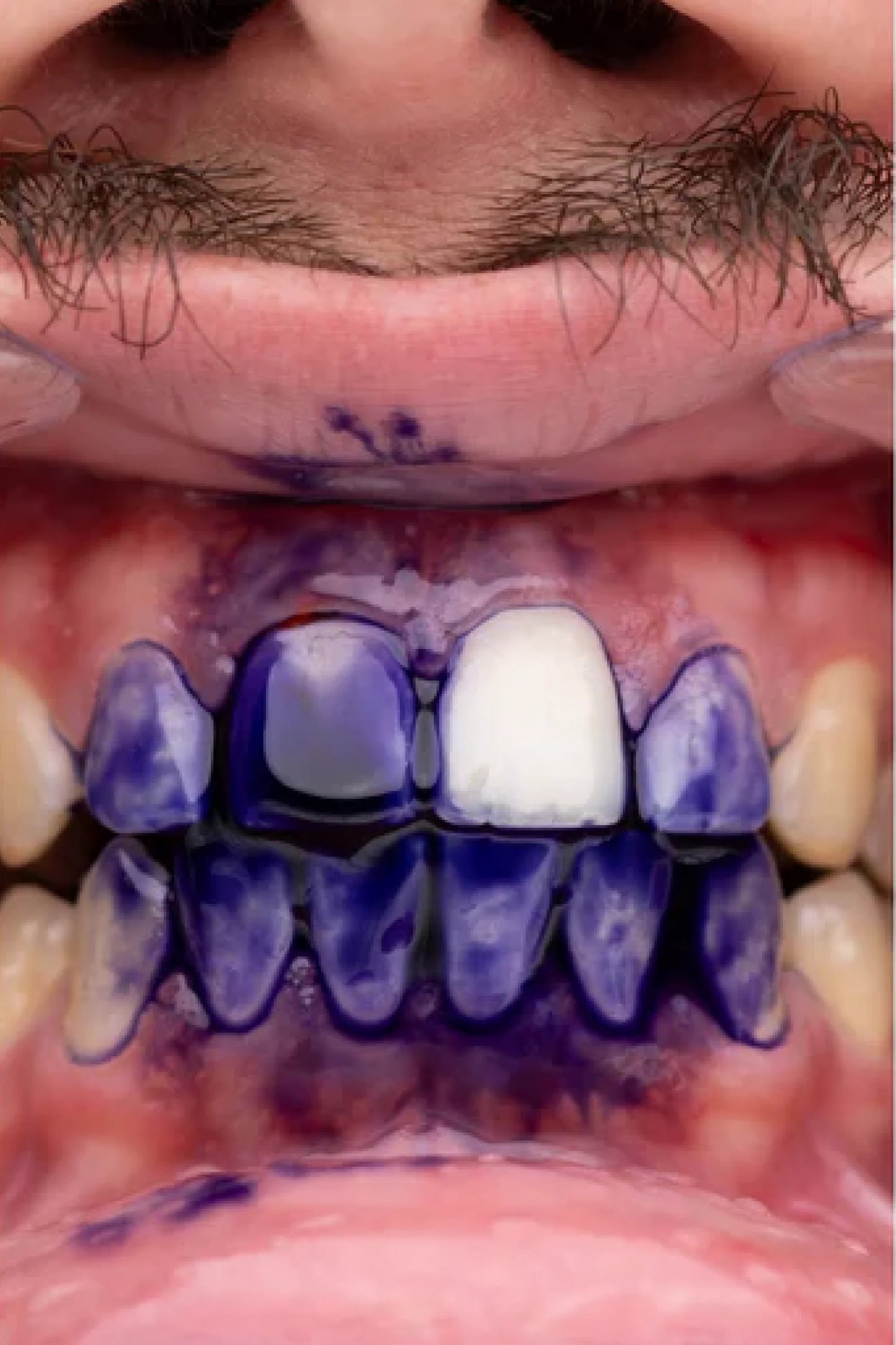 Gel Dental Blanqueador - Obsessive Smile